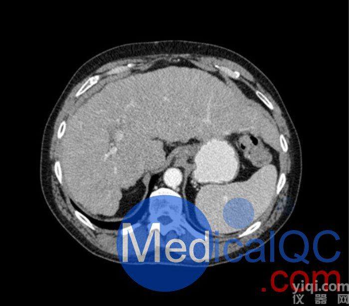 WEK53-04肝硬化腹部模體,WEK53-04門靜脈期腹部模體產(chǎn)品成像圖