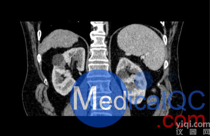 WEK53-04肝硬化腹部模體,WEK53-04門靜脈期腹部模體產(chǎn)品成像圖